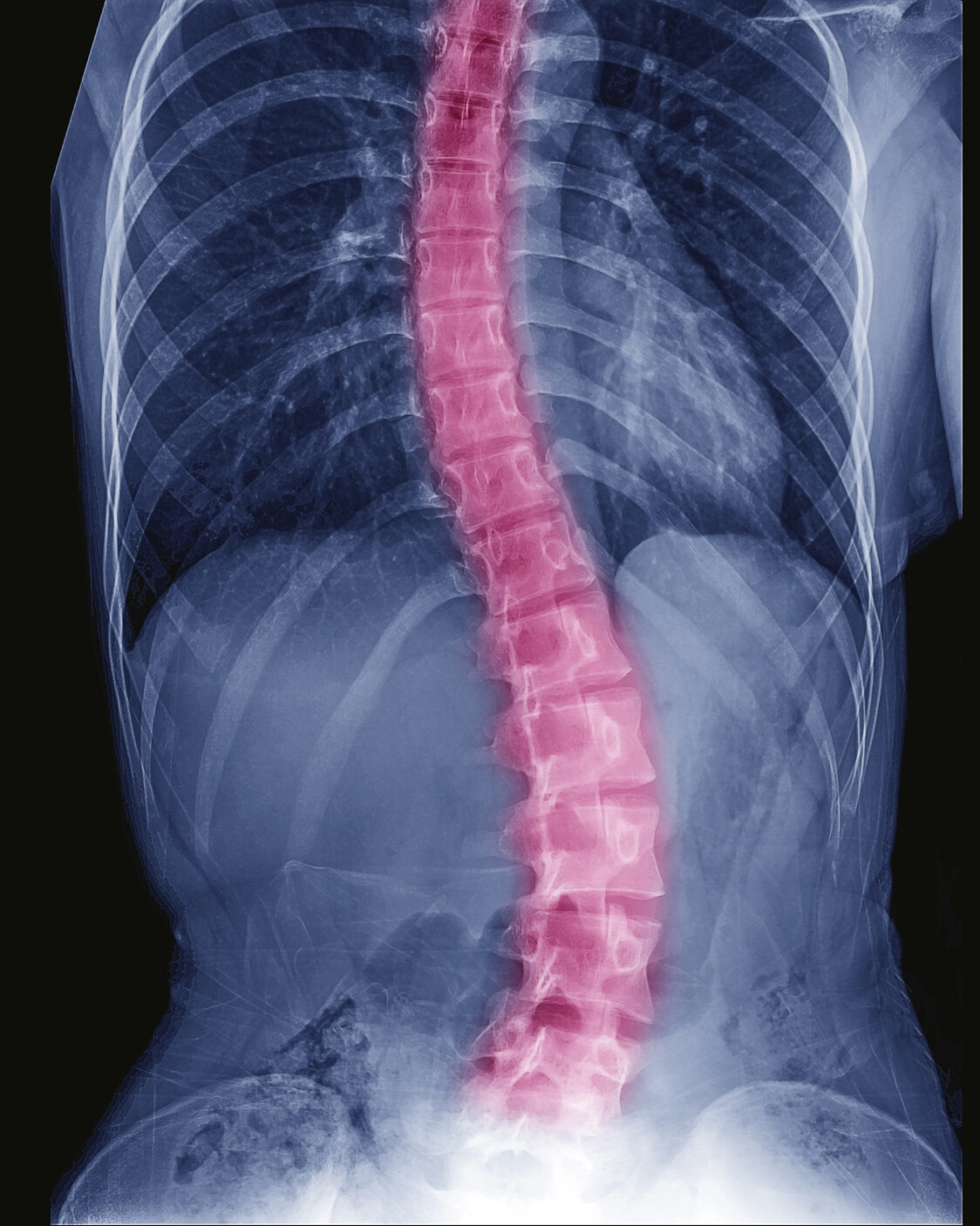 scoliosis body effects