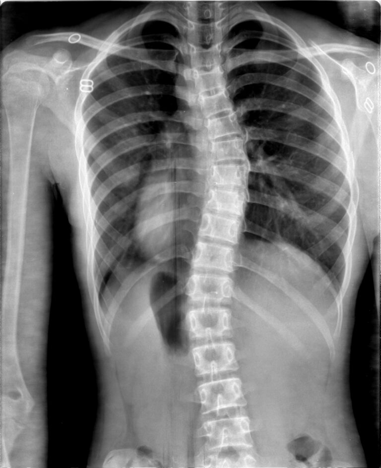 mild scoliosis